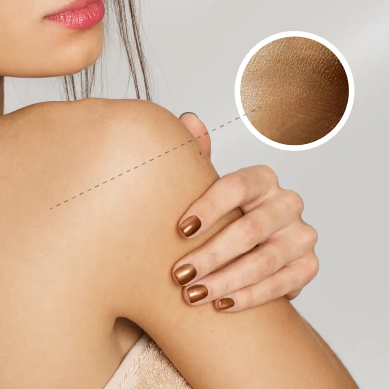 best cream for psoriasis