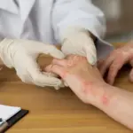 psoriasis cream