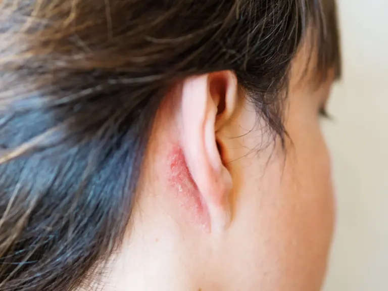 irritation-skin-ear-man-with-flaky-skin-allergy-fungal-disease-min (1)